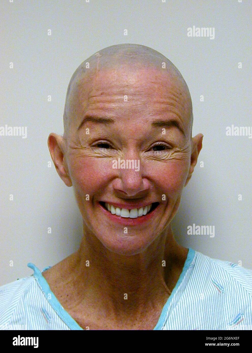 A bald American woman who suffers from epilepsy offers a big smile after her head was shaved in a hospital prior to an operation on her brain. Her hair was totally removed before the surgeon cut into her scalp and skull (cranium) to perform a temporal lobectomy, a surgery that can lower the number of seizures, make them less severe, or even stop them from happening. During this medical procedure, the doctor removes some of the temporal lobe of her brain where most seizures start. (2nd of 7 related images.) Model released. Stock Photo