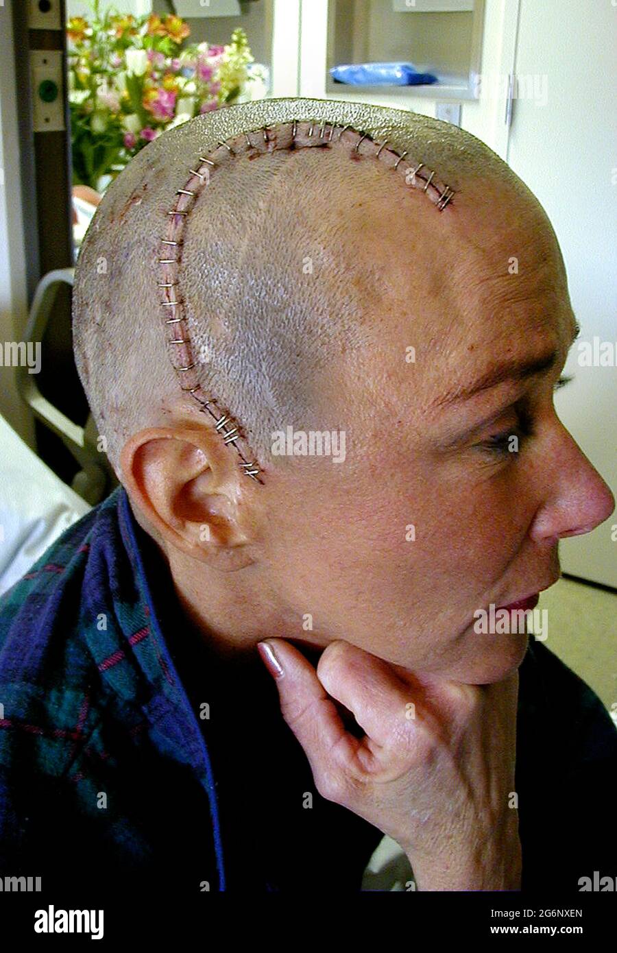 A bald American woman who suffered from epilepsy displays the stainless steel staples that were used to close a large incision in her head after an operation on her brain. Her hair was totally removed before the surgeon cut into her scalp and skull (cranium) to perform a temporal lobectomy, a surgery that can lower the number of seizures, make them less severe, or even stop them from happening. During this medical procedure, the doctor removed some of the temporal lobe of her brain where most seizures start. (4th of 7 related images.) Model released. Stock Photo