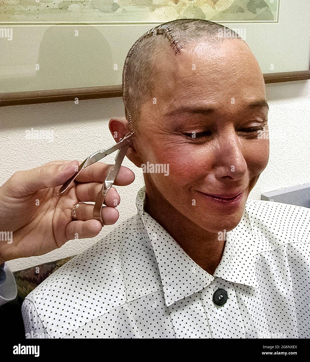 An American woman who suffered from epilepsy smiles as her hair grows back and a doctor removes the stainless steel staples that were used to close a large incision in her head after an operation on her brain. Her hair was shaved off before the surgeon cut into her scalp and skull (cranium) to perform a temporal lobectomy, a surgery that can lower the number of seizures, make them less severe, or even stop them from happening. During this medical procedure, the doctor removed some of the temporal lobe of her brain where most seizures start. (5th of 7 related images.) Model released. Stock Photo