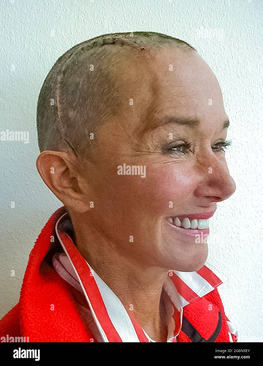 An American woman who suffered from epilepsy smiles as her hair grows in and healing continues on the large incision in her head that was closed with stainless steel staples after an operation on her brain. Her hair was shaved off before the surgeon cut into her scalp and skull (cranium) to perform a temporal lobectomy, a surgery that can lower the number of seizures, make them less severe, or even stop them from happening. During this medical procedure, the doctor removed some of the temporal lobe of her brain where most seizures start. (6th of 7 related images.) Model released. Stock Photo