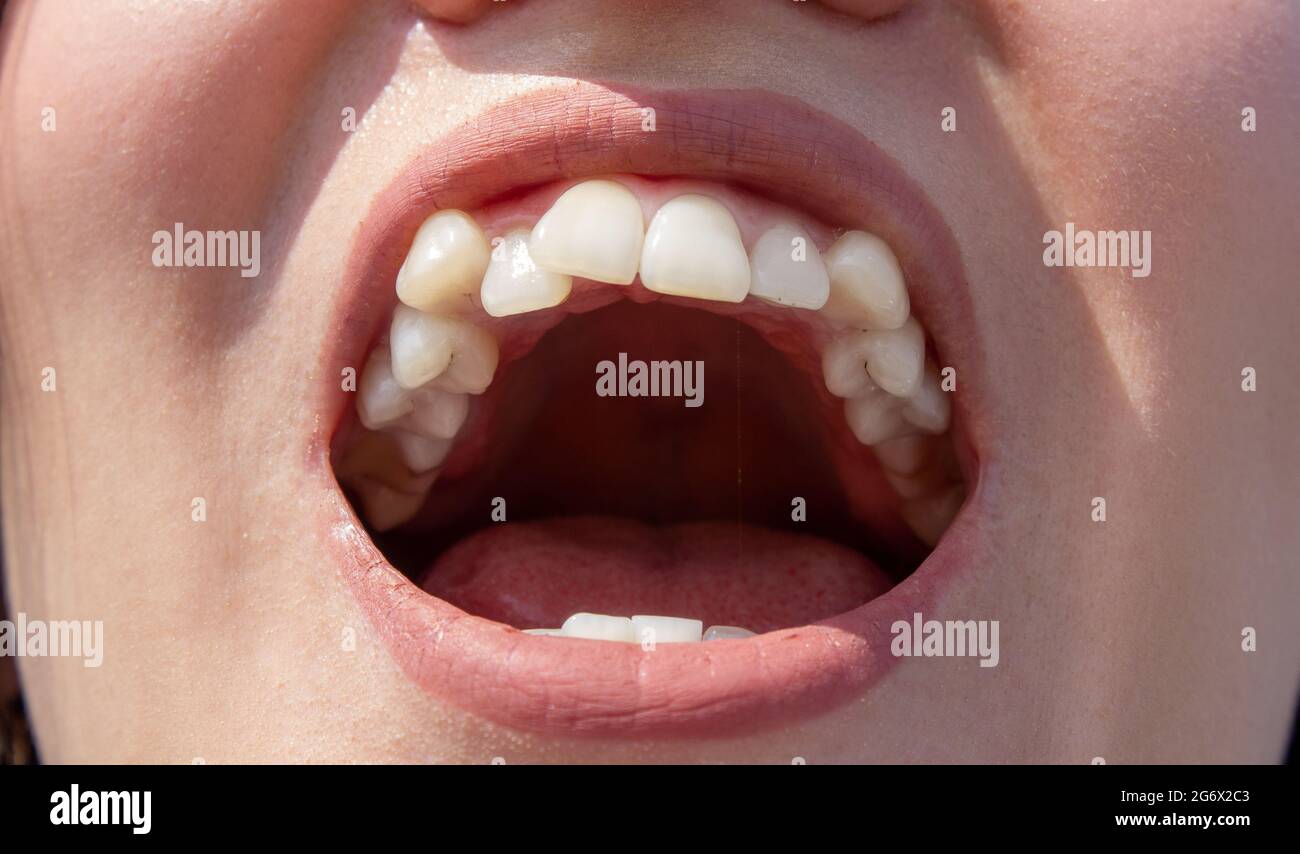 Curved female teeth, before installing braces. Close up of teeth