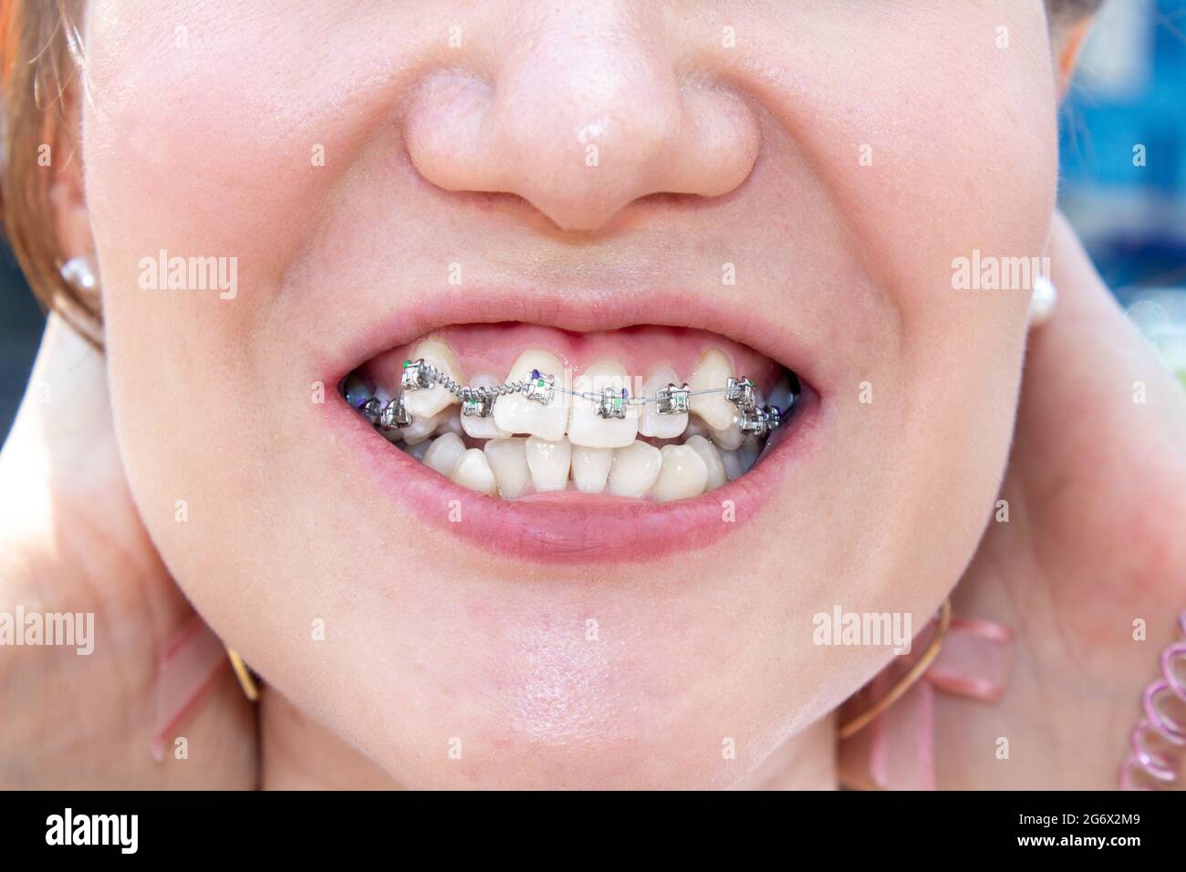 Curved female teeth, after installing braces. Closeup of the teeth