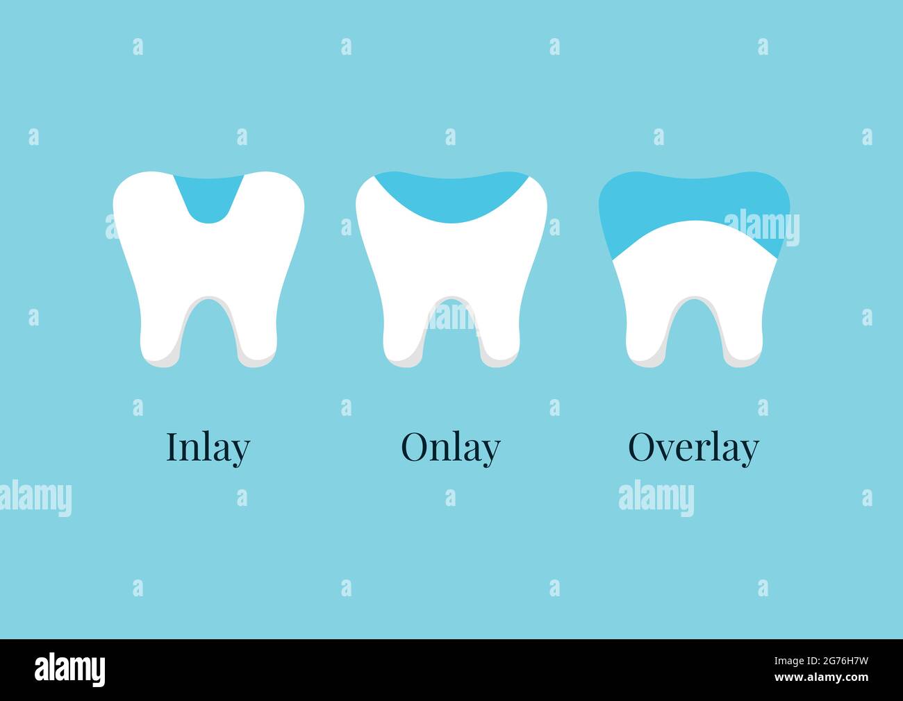 Tooth dental ceramic inlay, onlay, overlay or crown treatment set. Stock Vector