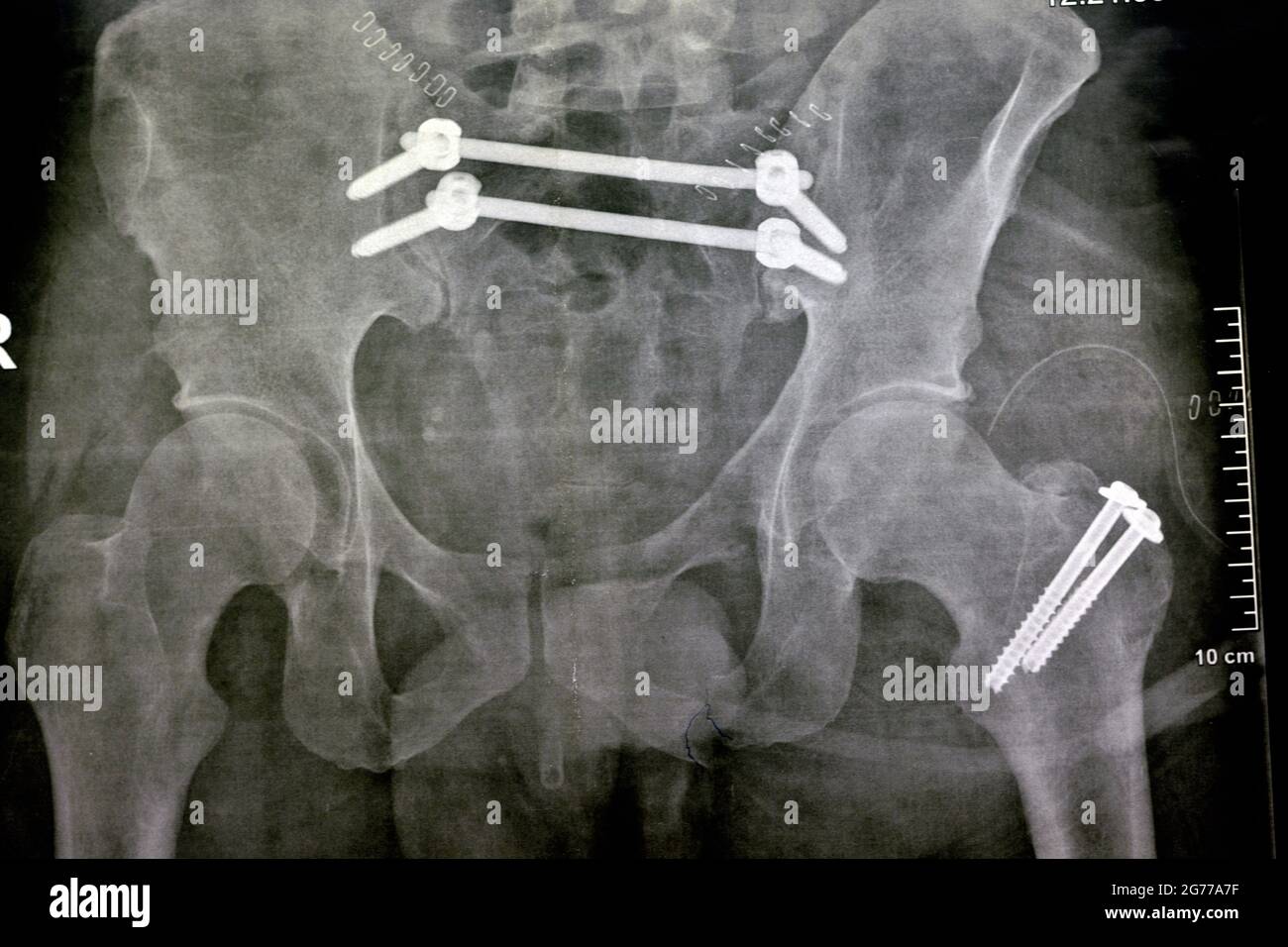 Plain x ray with a fracture pelvis that is fixed with 4 screws and 2 rods and fracture of greater trochanter of femur fixed with 2 screws Stock Photo