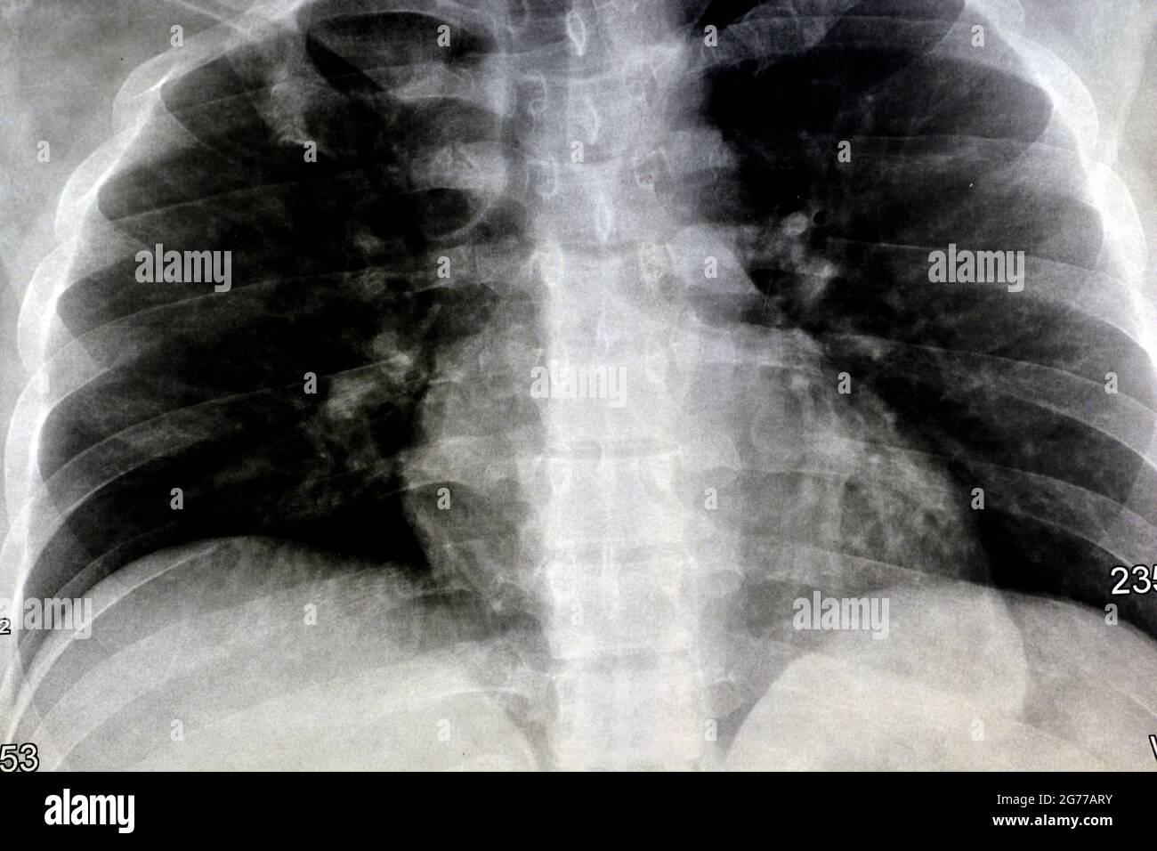 plain chest X-ray, almost normal human chest x ray yet with some congestion resulted from smoking and chronic bronchitis, heart shadow is within norma Stock Photo