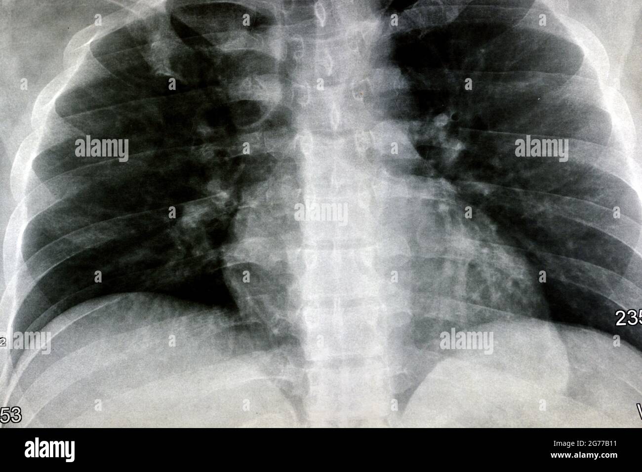 plain chest X-ray, almost normal human chest x ray yet with some congestion resulted from smoking and chronic bronchitis, heart shadow is within norma Stock Photo