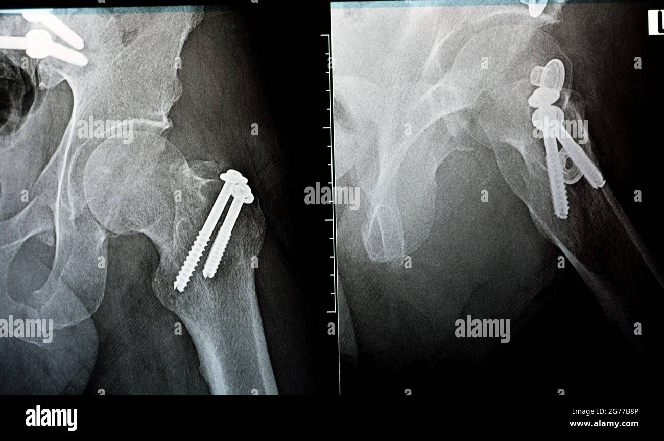 plain x ray on left hip joined with a fracture of the greater trochanter of femur fixed with 2 screws in an open reduction surgery Stock Photo