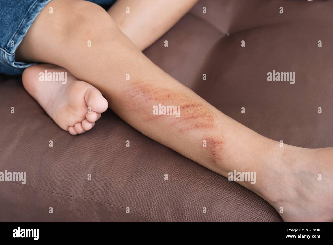 Wounds, scratches and abrasions on skin of child leg. Children injury