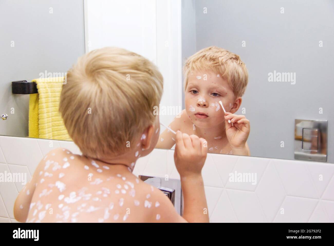 Toddler  blonde boy sick with chickenpox measles on the body uses the medicine. Varicella virus childhood contagious disease. Itchy red blisters, feve Stock Photo