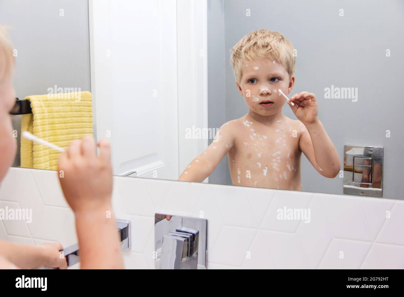 Toddler  blonde boy sick with chickenpox measles on the body uses the medicine. Varicella virus childhood contagious disease. Itchy red blisters, feve Stock Photo