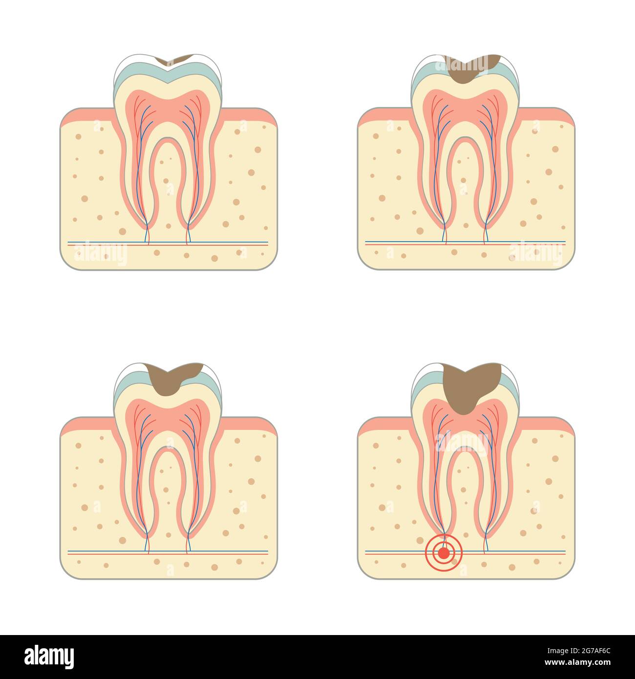 tooth decay disease, dental root tinfection Stock Vector