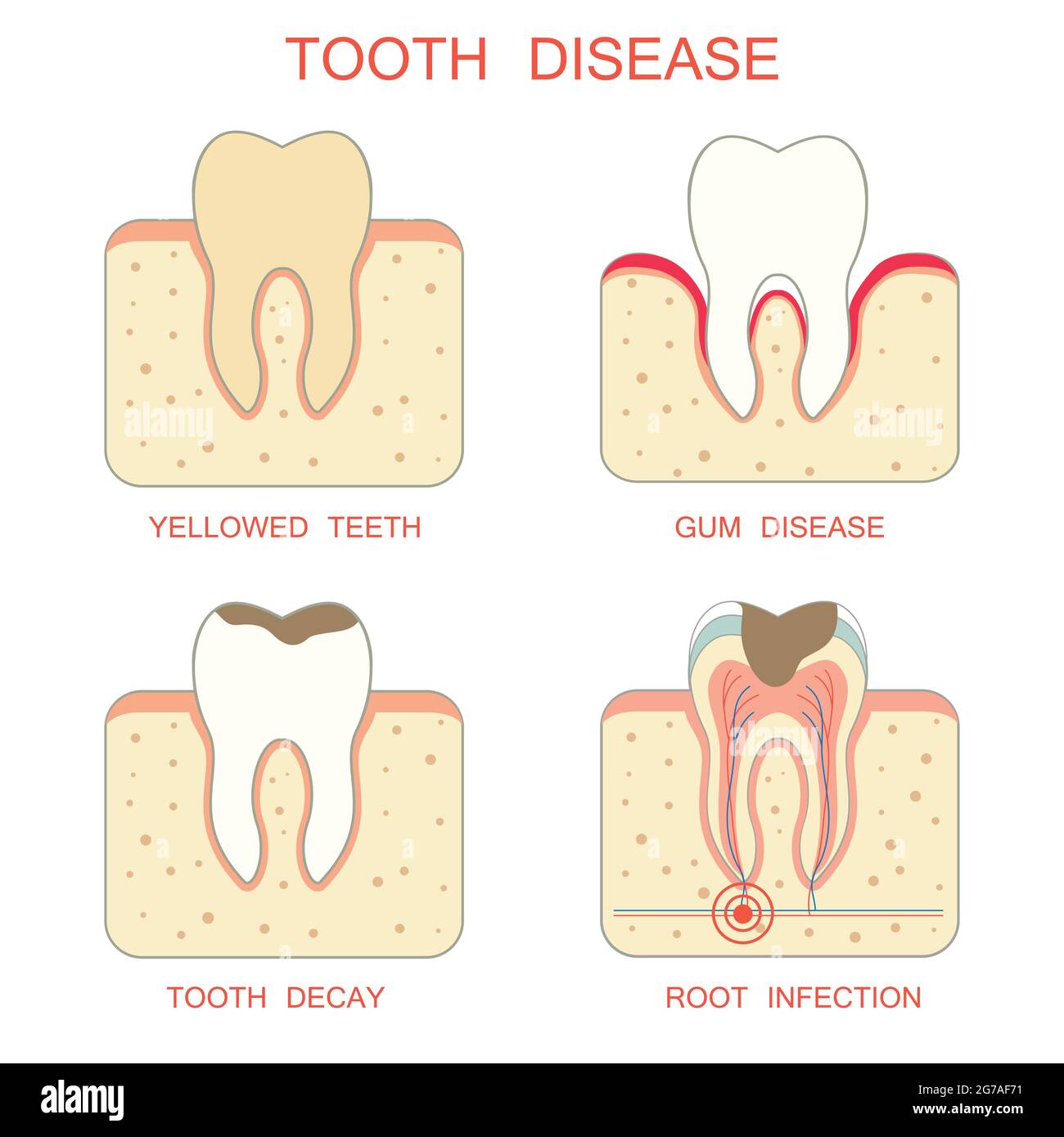 tooth decay disease,periodontal gum, yellowed teeth, root infection Stock Vector