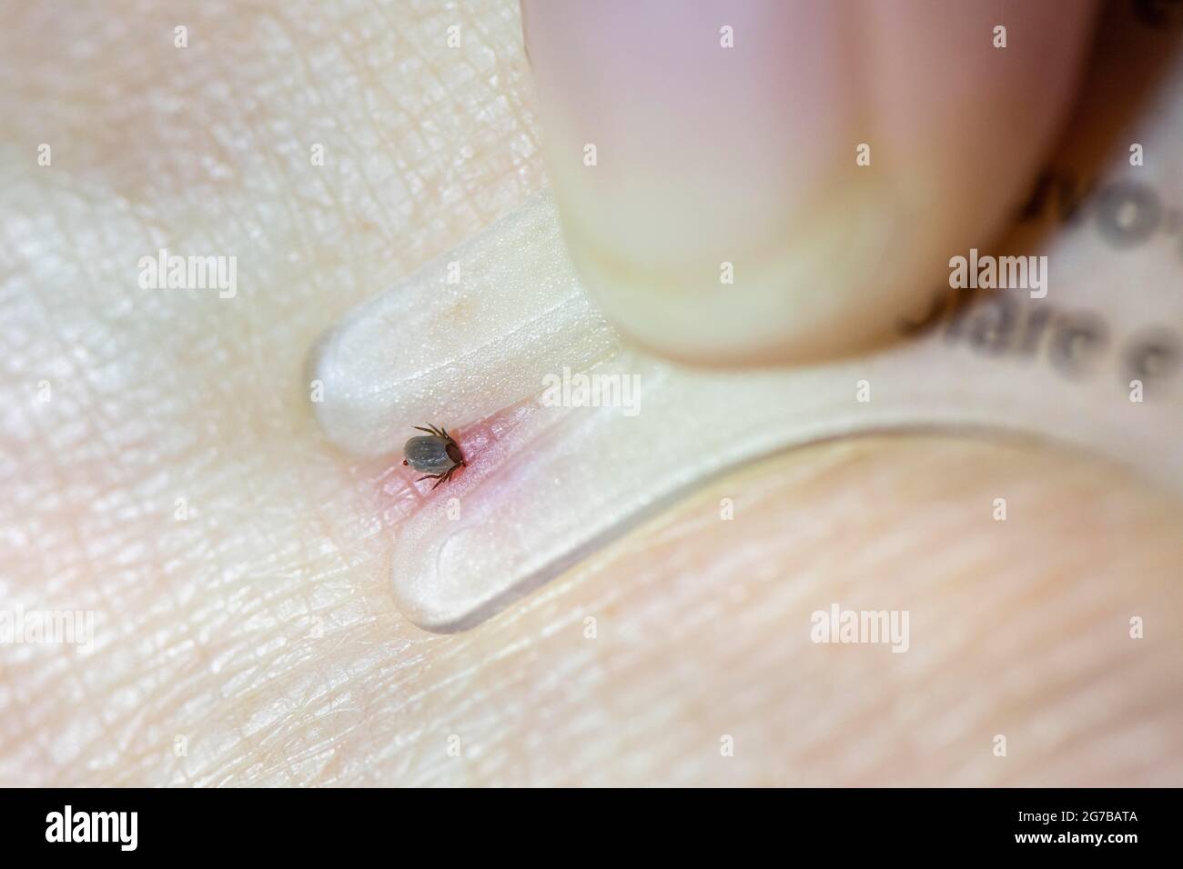 Castor Bean Tick (Ixodes ricinus), tick on human skin, tick bite, removal by tick card Stock Photo