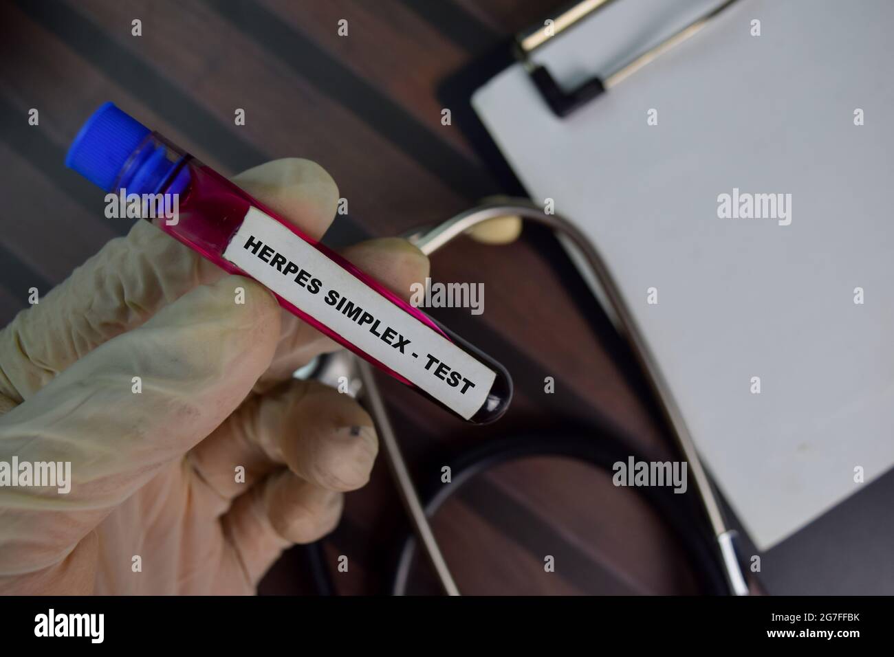 herpes-simplex-test-test-with-blood-sample-top-view-isolated-on-office-desk-healthcare