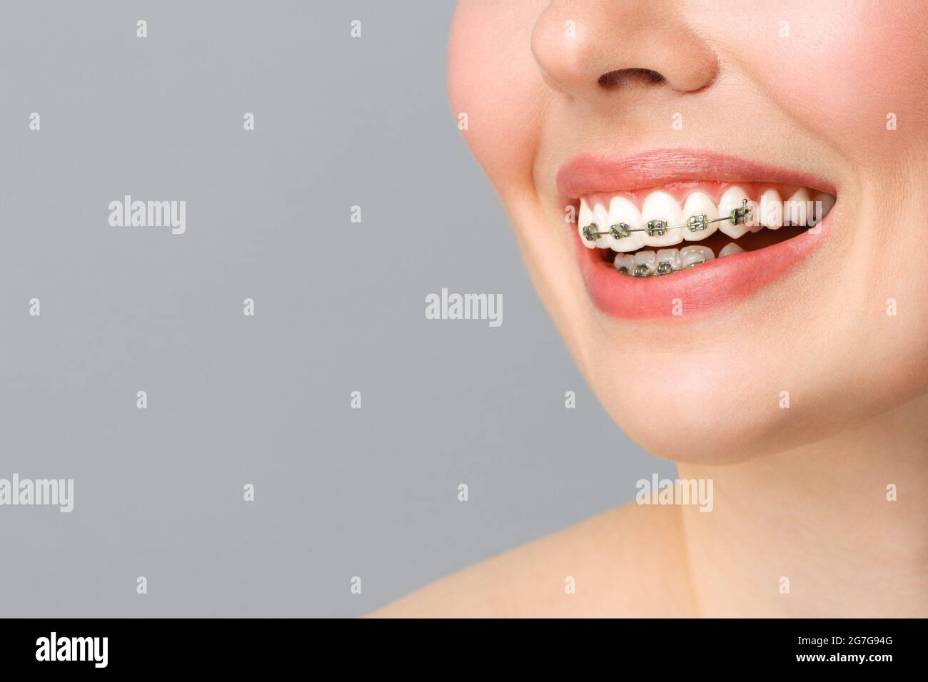 Premium Photo Orthodontic Treatment Dental Care Concept Beautiful Woman  Healthy Smile Close Up Closeup Ceramic And Metal Brackets On Teeth Beautiful  Female Smile With Braces | Smile Braces | inspirations-ahs.com