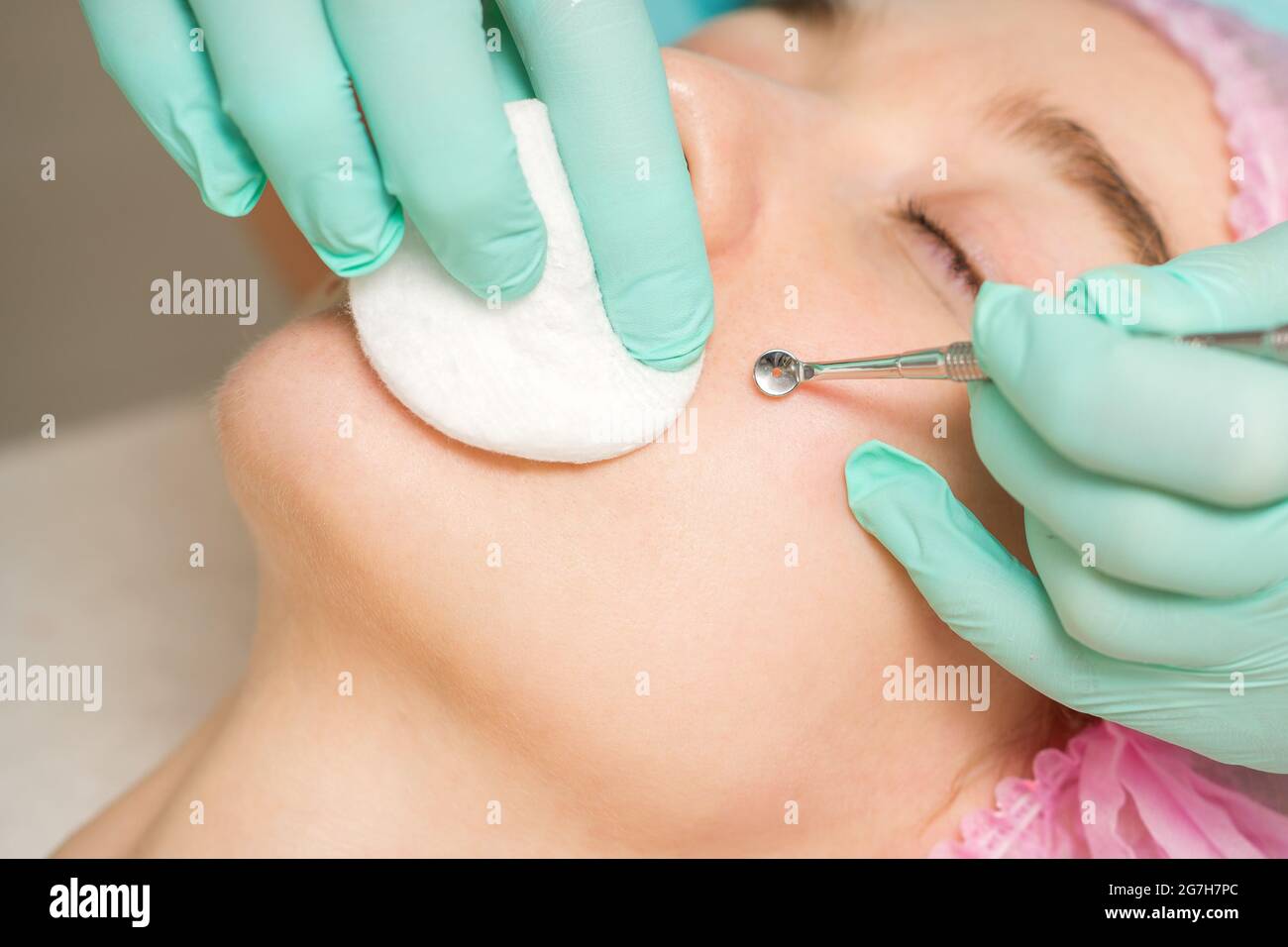 The beautician removes blackhead and acne on the female face in a beauty  salon, blackhead removal tool Stock Photo - Alamy