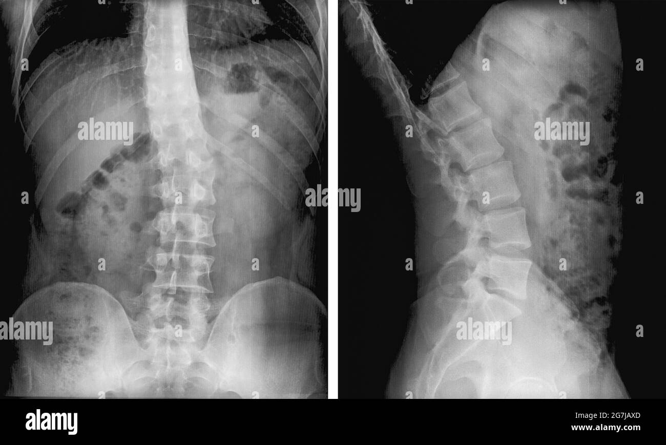 Spine Scoliosis X Ray