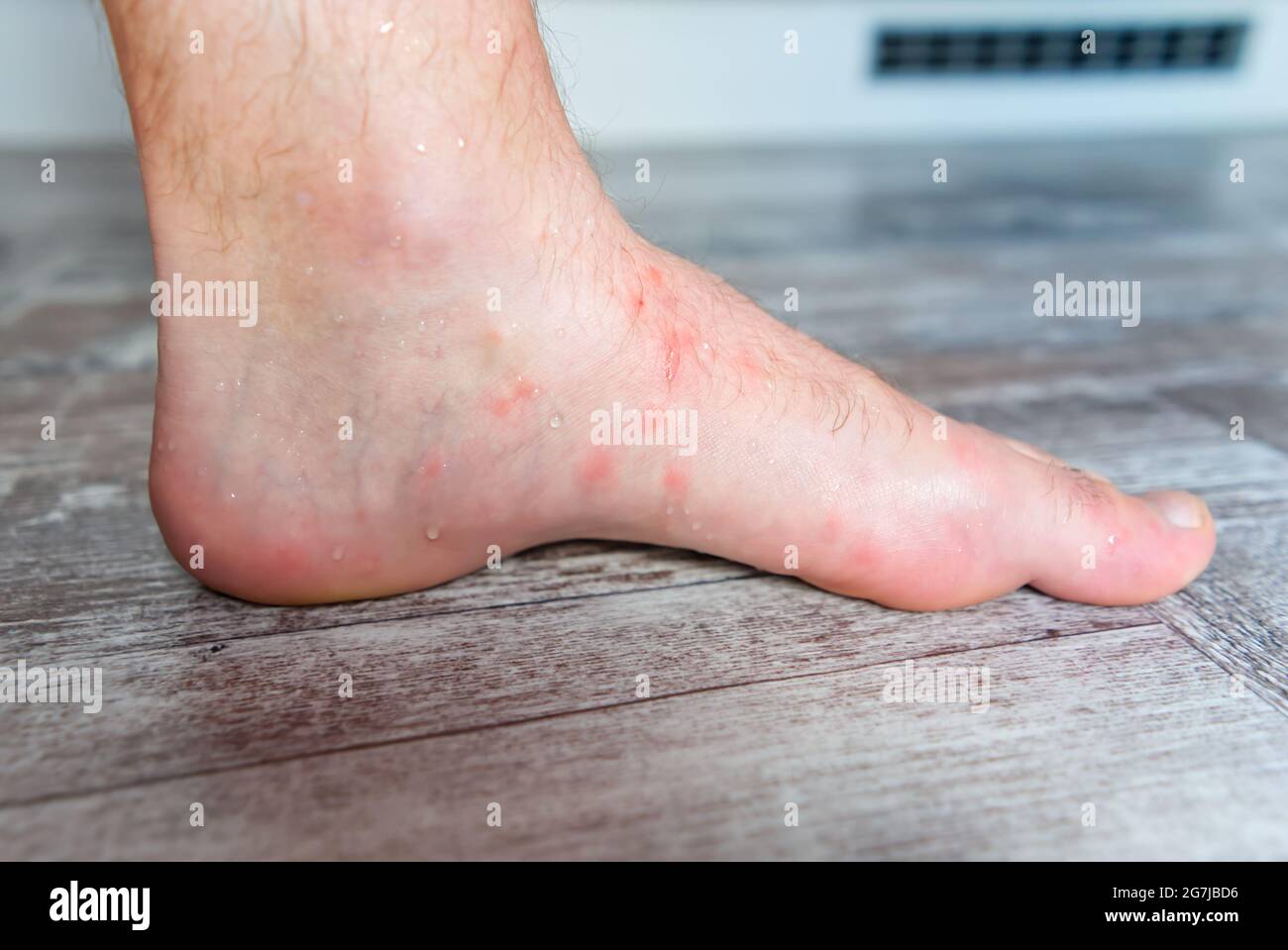 close up on many mosquito bites on men's foot skin Stock Photo Alamy