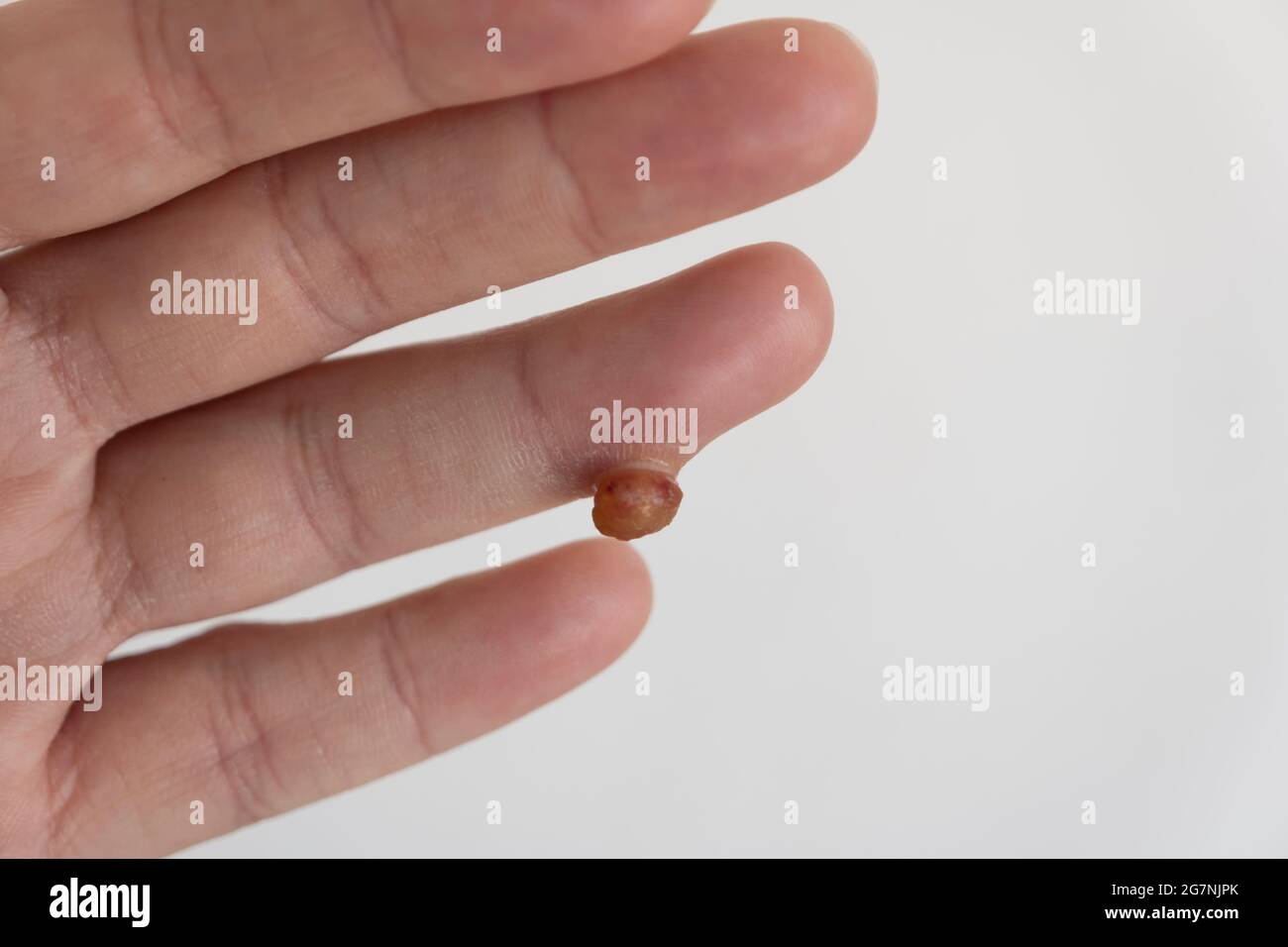 Protruding soft tissue tumor in finger on white background Stock Photo
