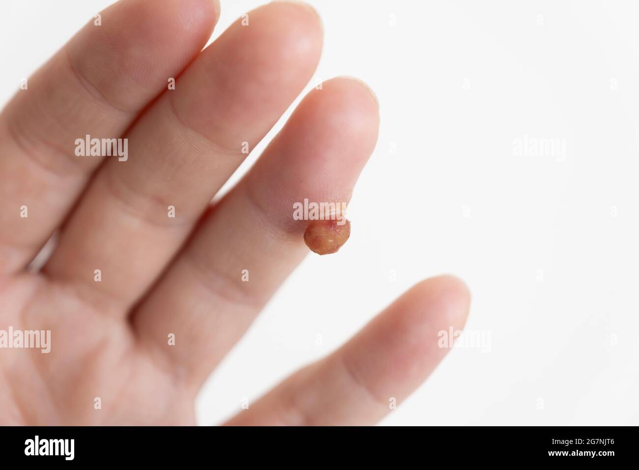 Protruding soft tissue tumor in finger on white background Stock Photo