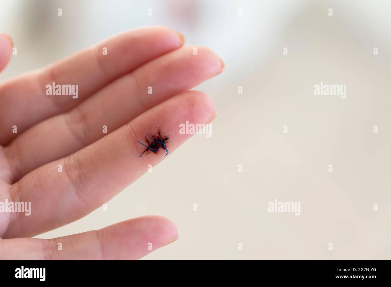 A wound on a woman's finger was treated with surgical sutures. Stock Photo