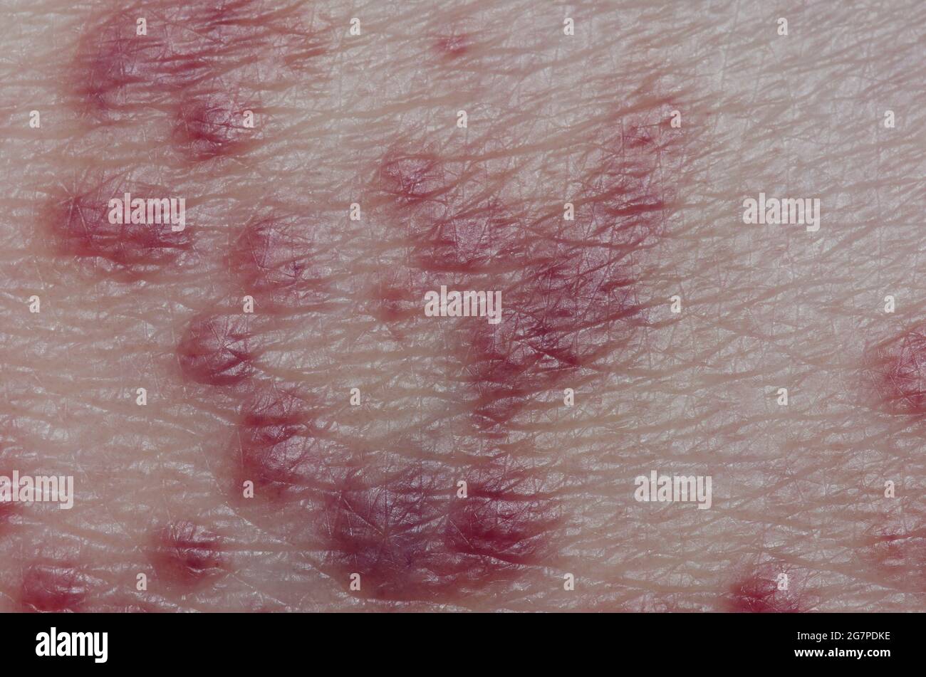 Rash on human skin due to chiggers, Family Trombiculidae Stock Photo