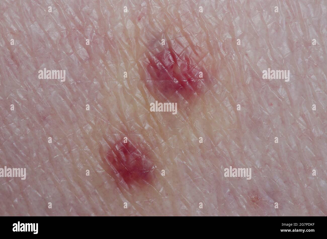 Rash on human skin due to chiggers, Family Trombiculidae Stock Photo