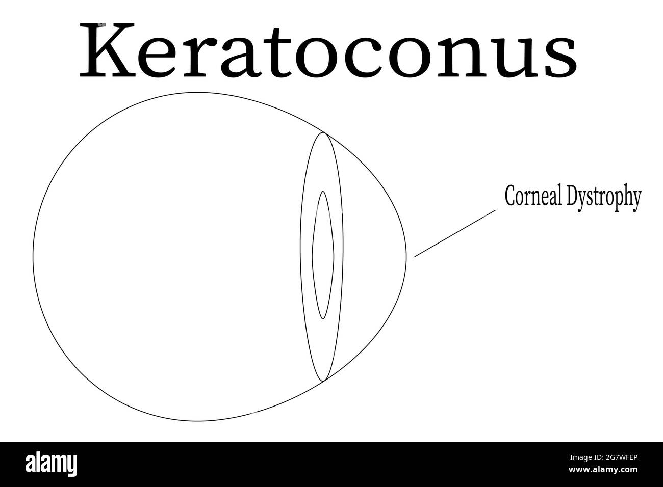 diagnosis Keratoconus corneal dystrophy illustration. Stock Photo