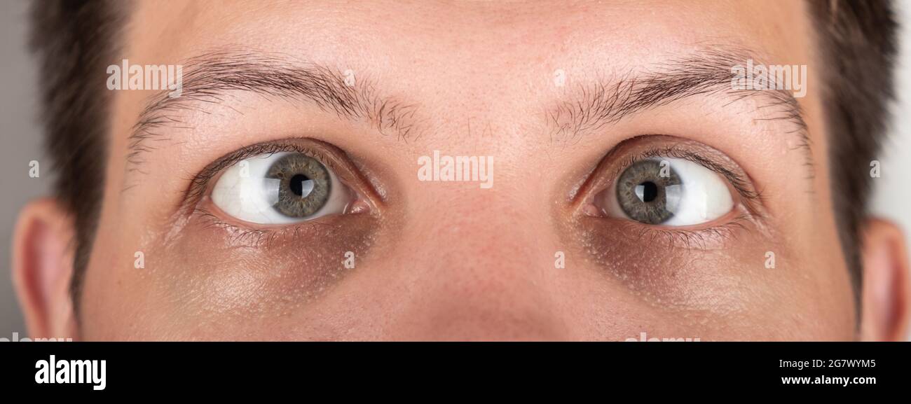 strabismus of a man's eyes close-up panorama. Stock Photo