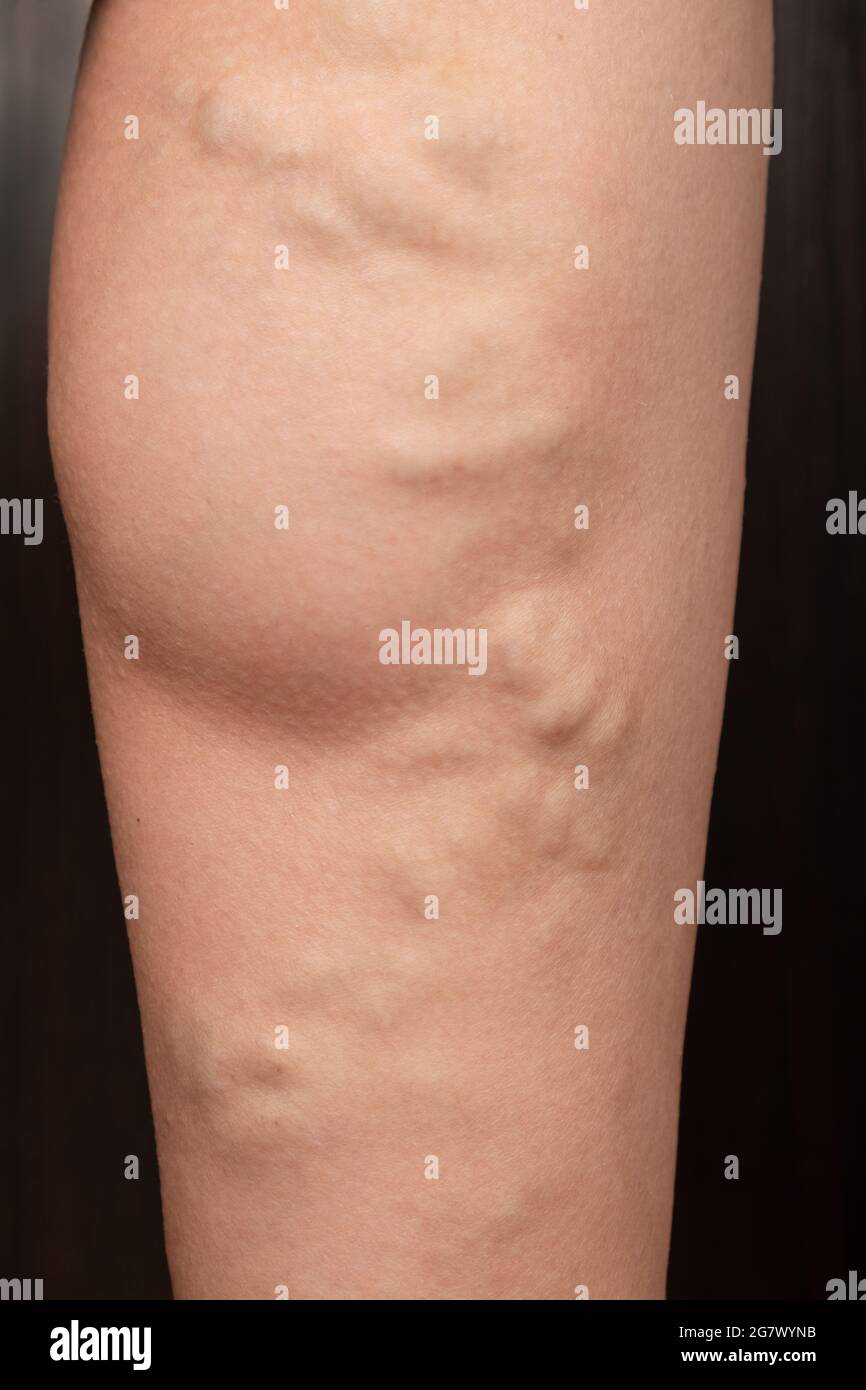 phlebeurysm, varicose veins of the lower extremities close-up, peripheral vascular disease. Stock Photo