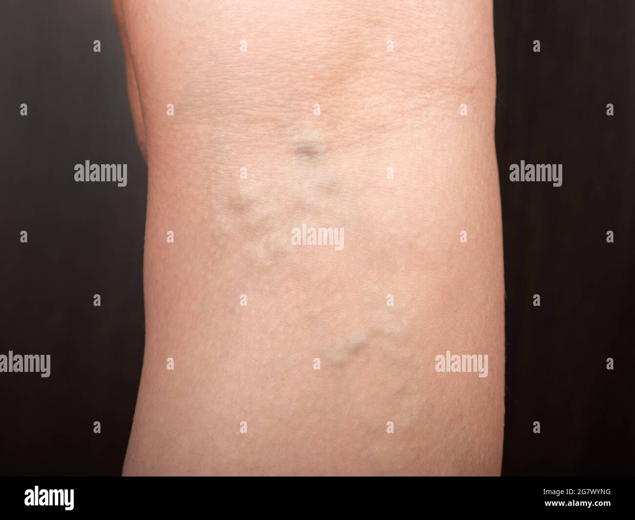 phlebeurysm, varicose veins of the lower extremities close-up, peripheral vascular disease. Stock Photo