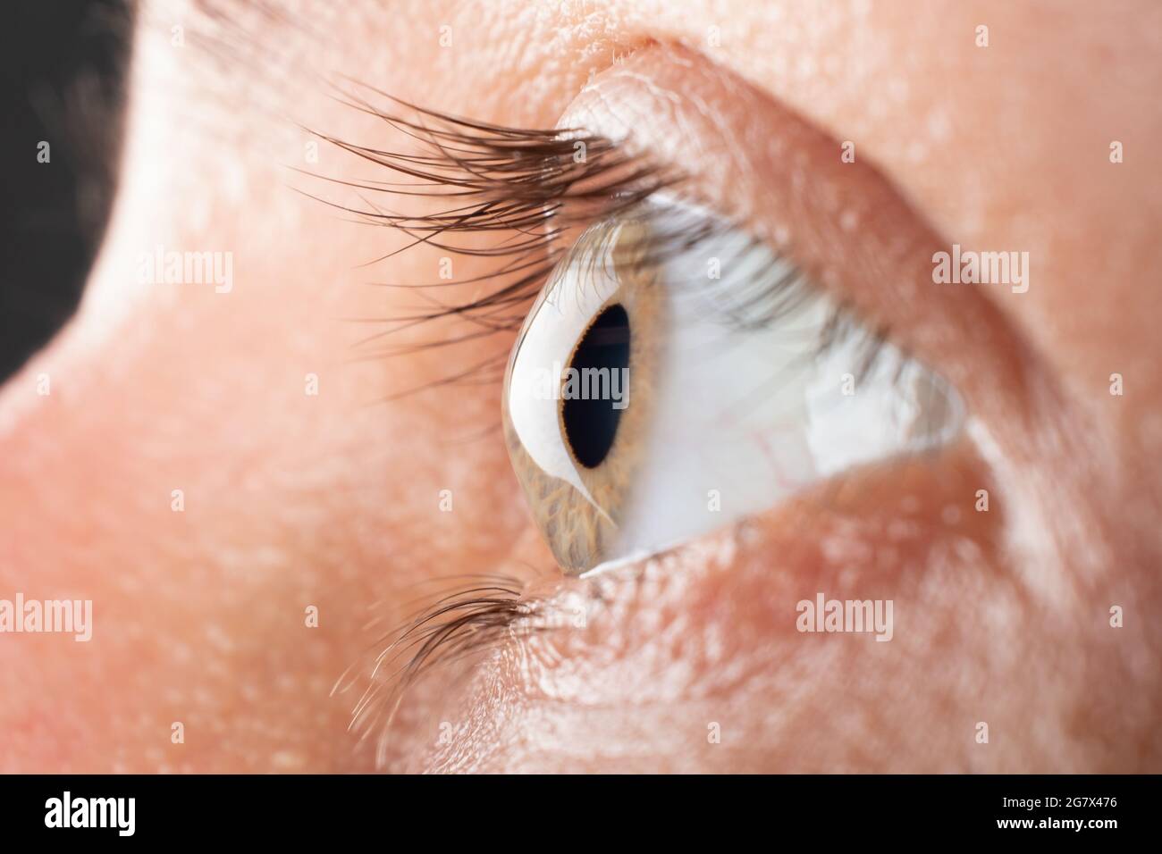 woman eye closeup with 3 stage of keratoconus, corneal dystrophy. Stock Photo