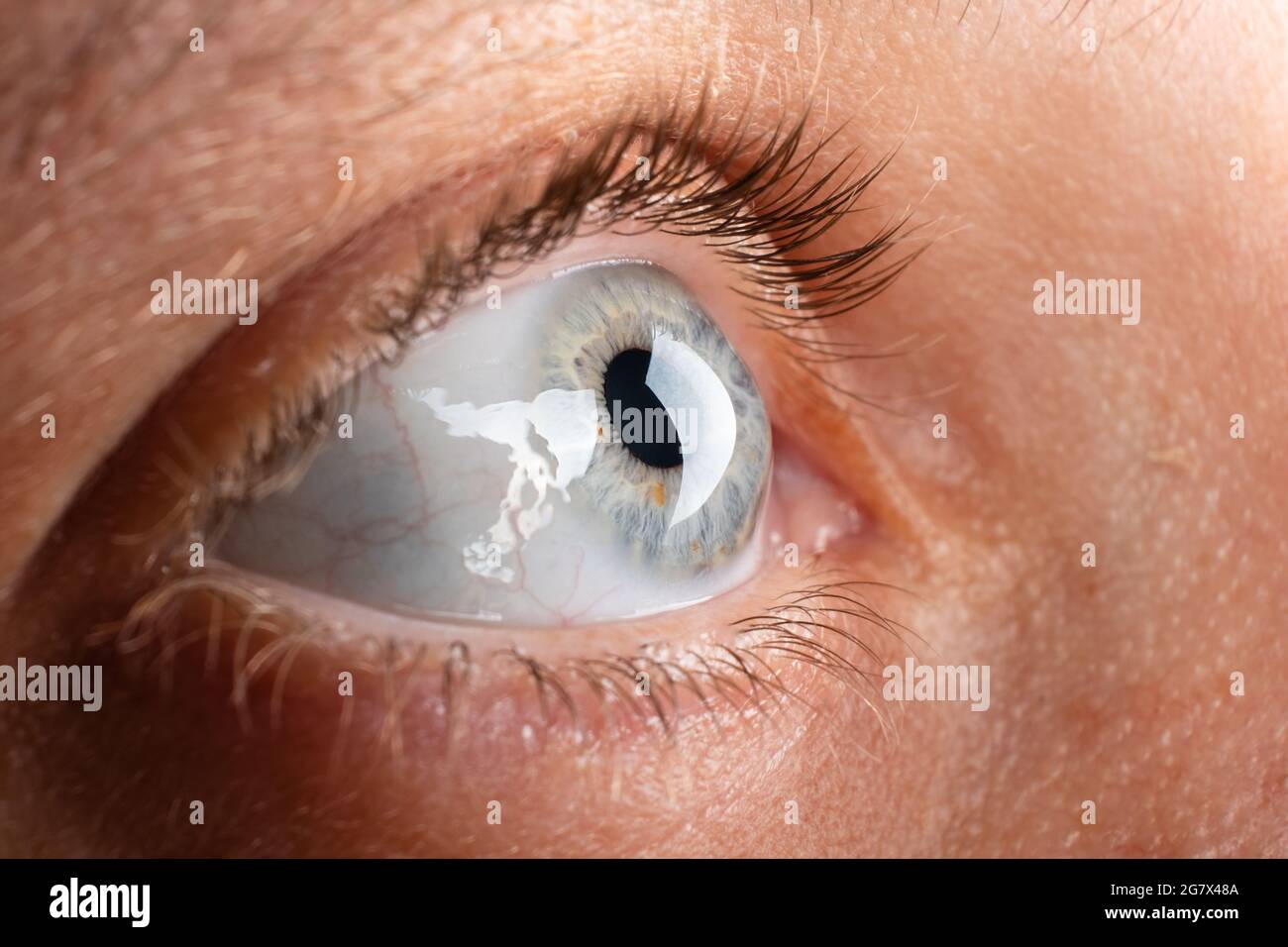beautiful female eye, diagnosis of keratoconus corneal dystrophy. Stock Photo