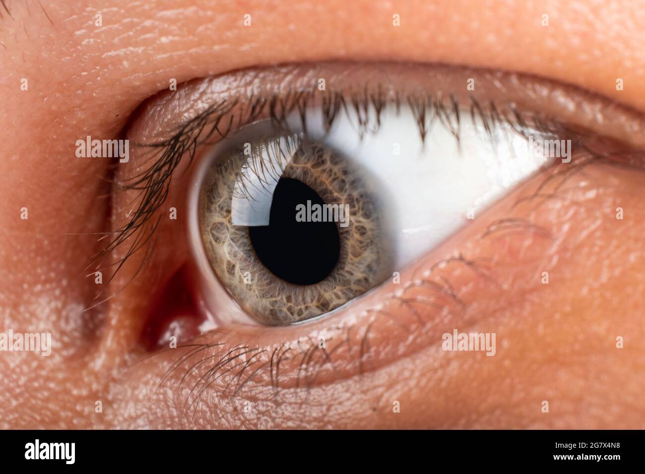 patient with keratokonus eye closeup, corneal dystrophy diagnosis. Stock Photo