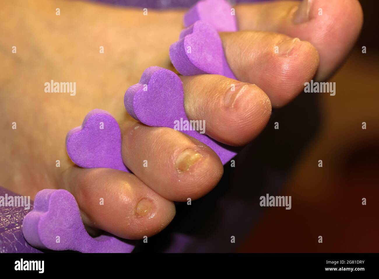 Finger separators hires stock photography and images Alamy
