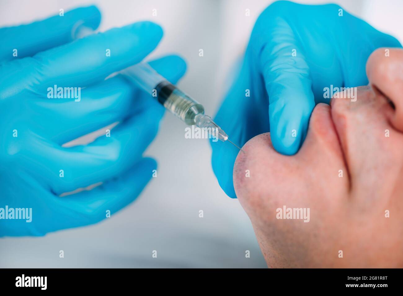 Dermal filler face treatment Stock Photo Alamy