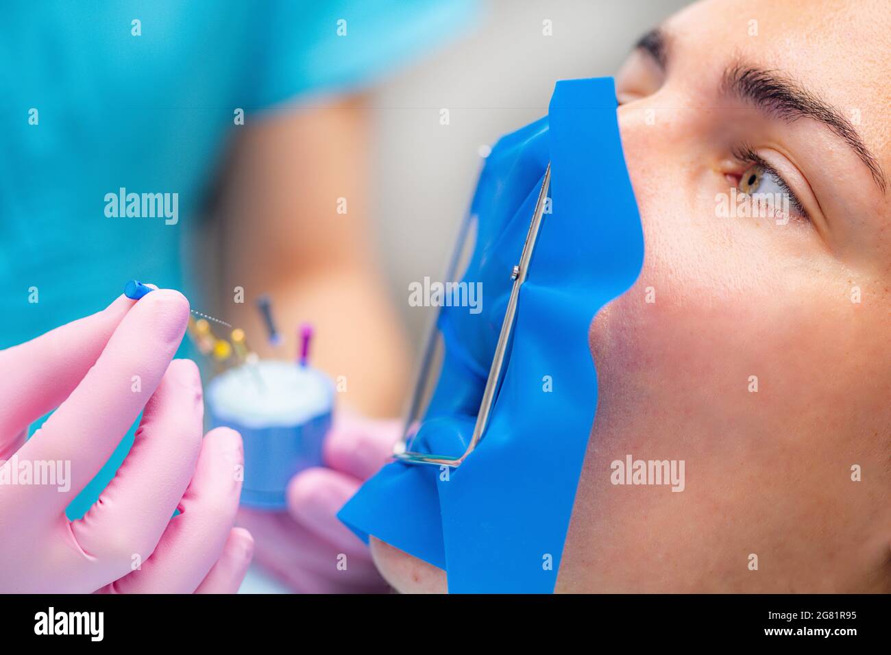 Endodontist setting barbed broach for endodontic treatment Stock Photo