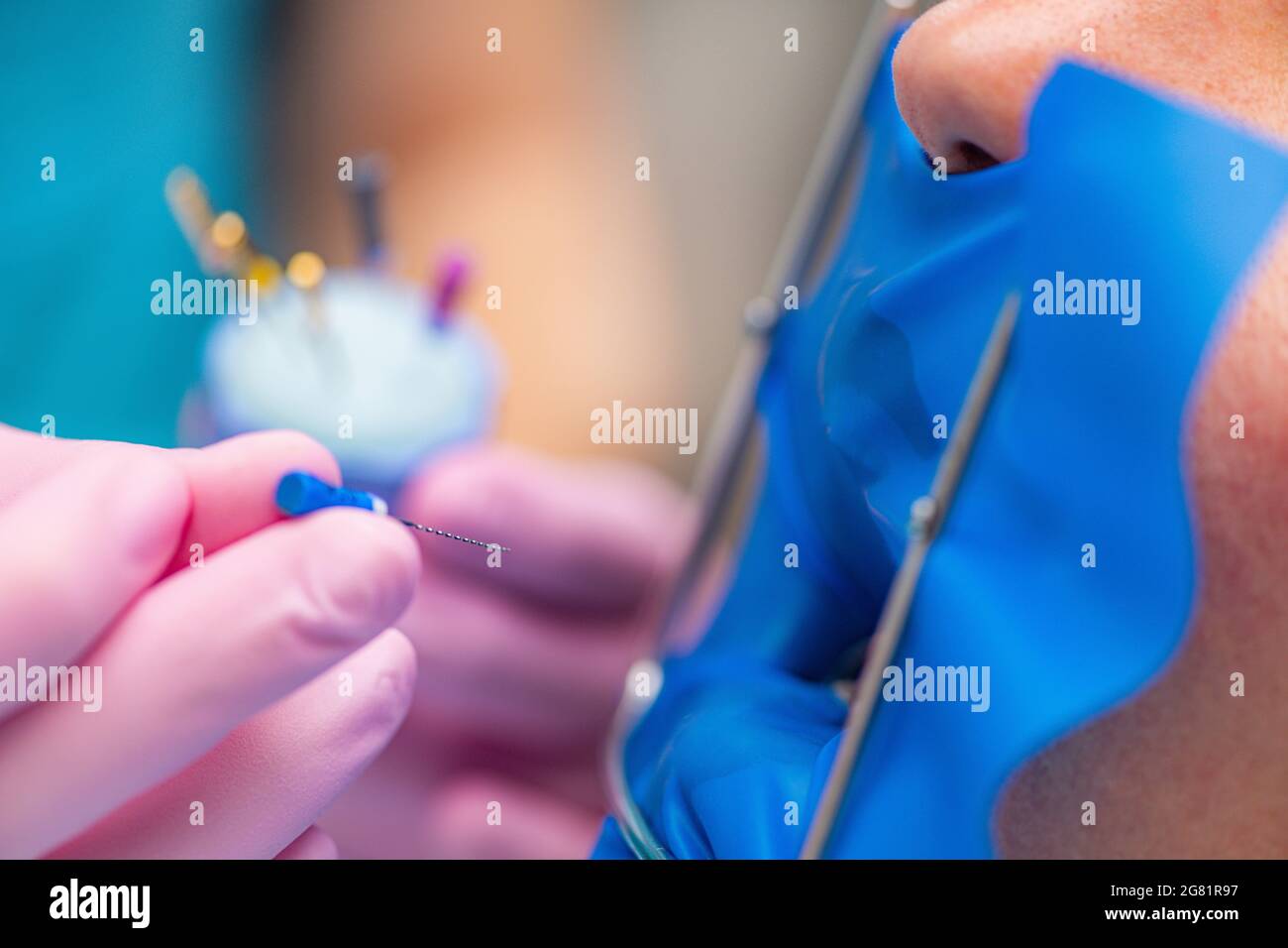 Endodontic root canal treatment Stock Photo Alamy