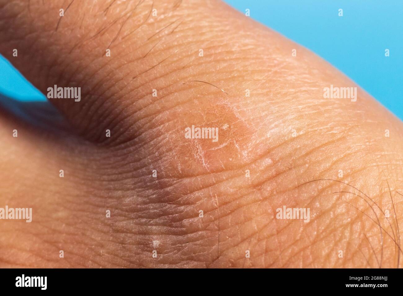 Dehydrated Skin High Resolution Stock Photography and Images Alamy
