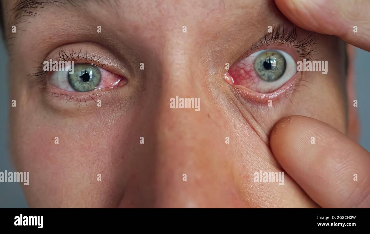 Sore eyes hires stock photography and images Alamy
