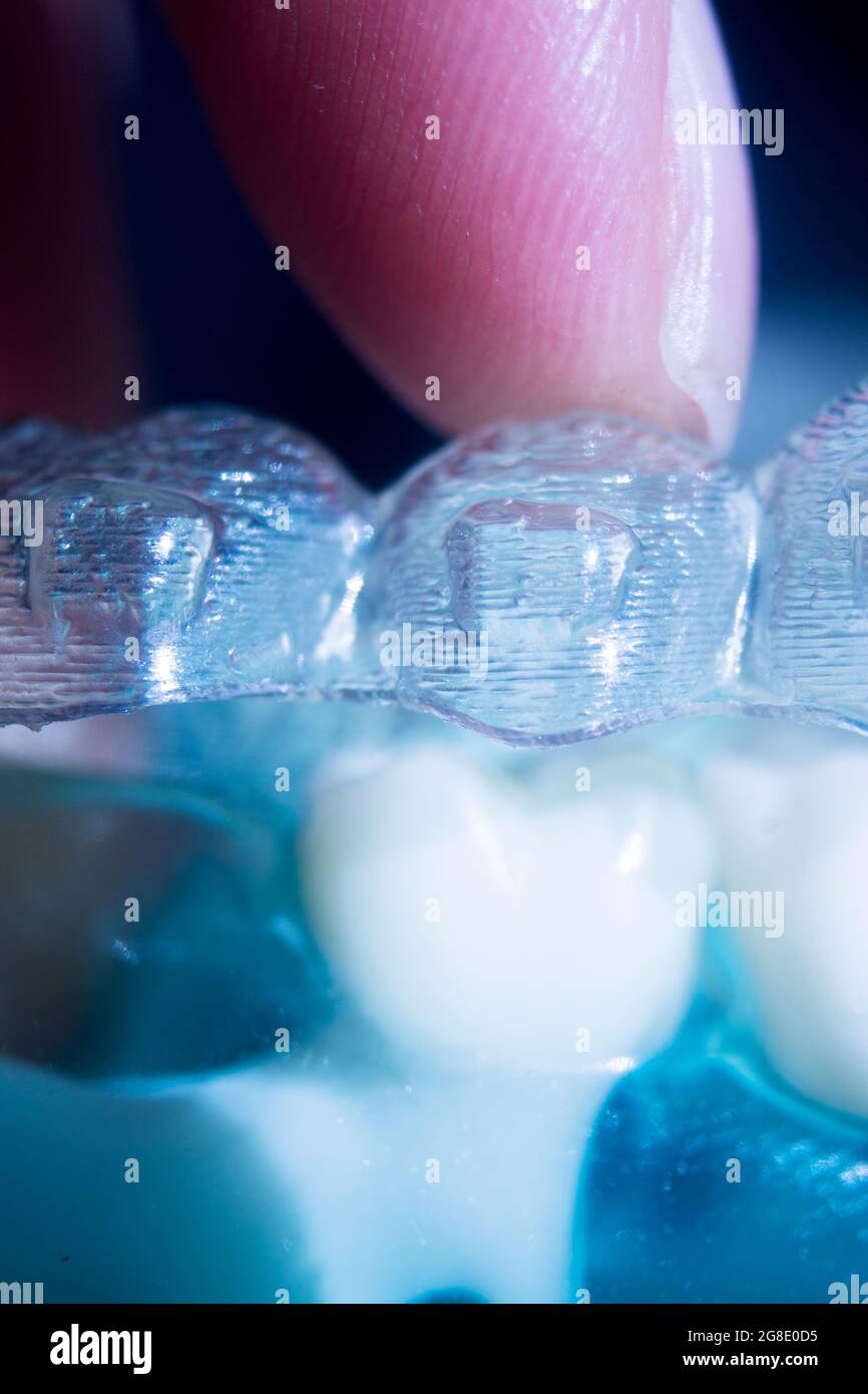 Modern invisible brackets aligner straighterners used to correct