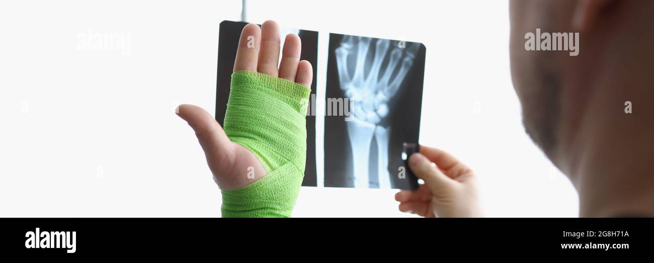 A man looks at an X-ray and an injured arm in a bandage. A man thinks about trauma and treatments Stock Photo