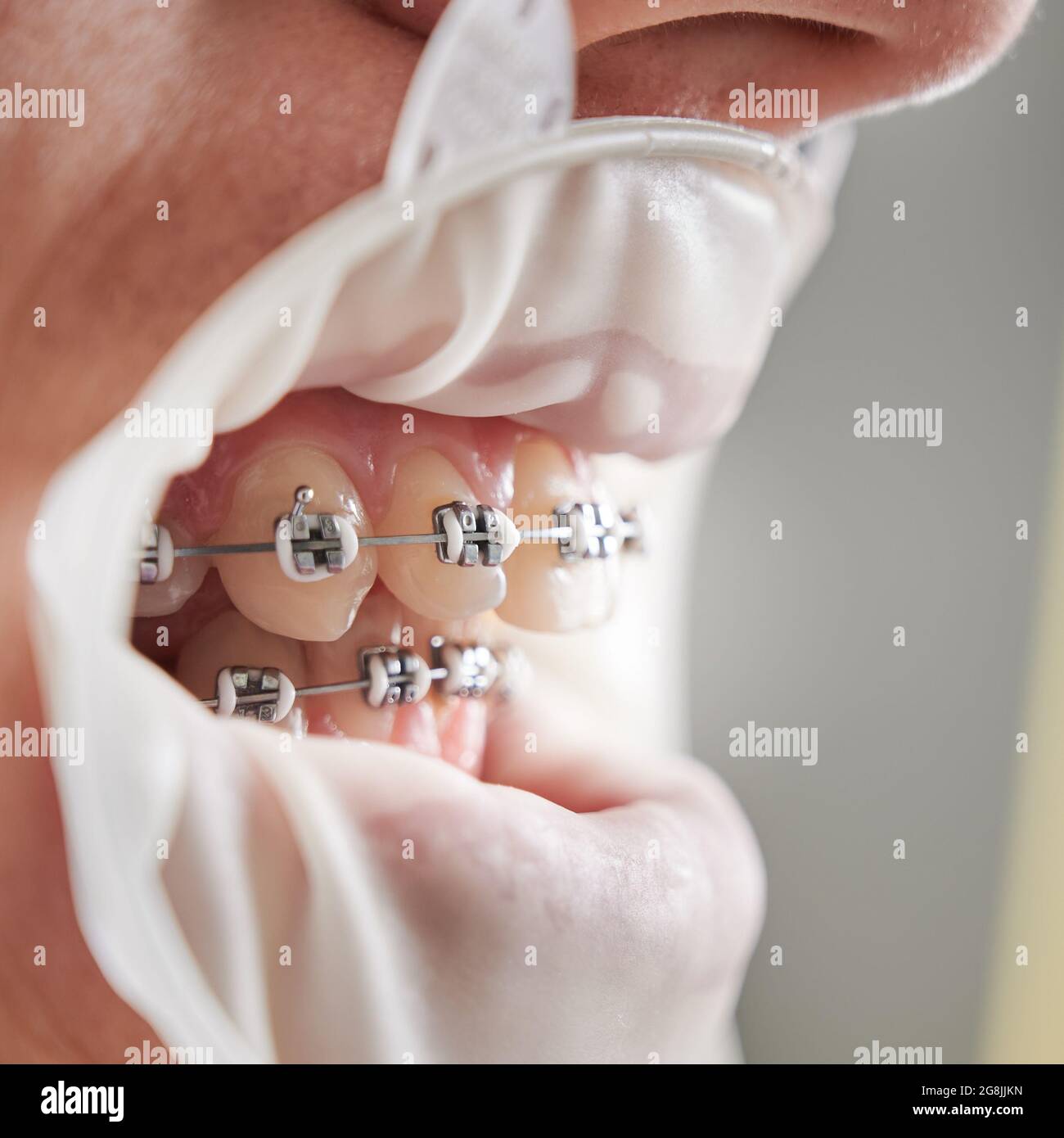Close up of man with sterile rubber dam cheek retractor in mouth showing teeth with wired metal