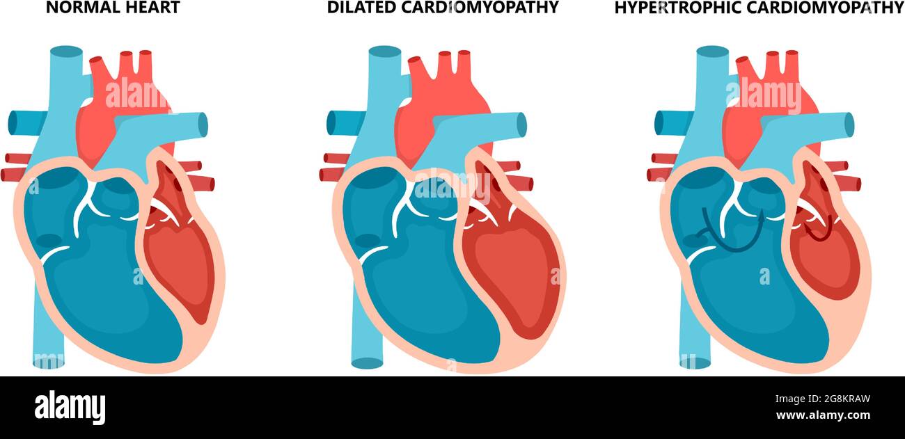 Types of heart diseases - normal, hypertrophic and dilated ...