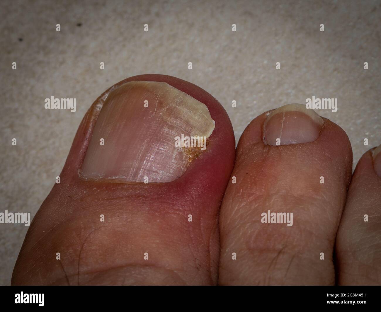 foot toe with dermatological problems on nail Stock Photo - Alamy