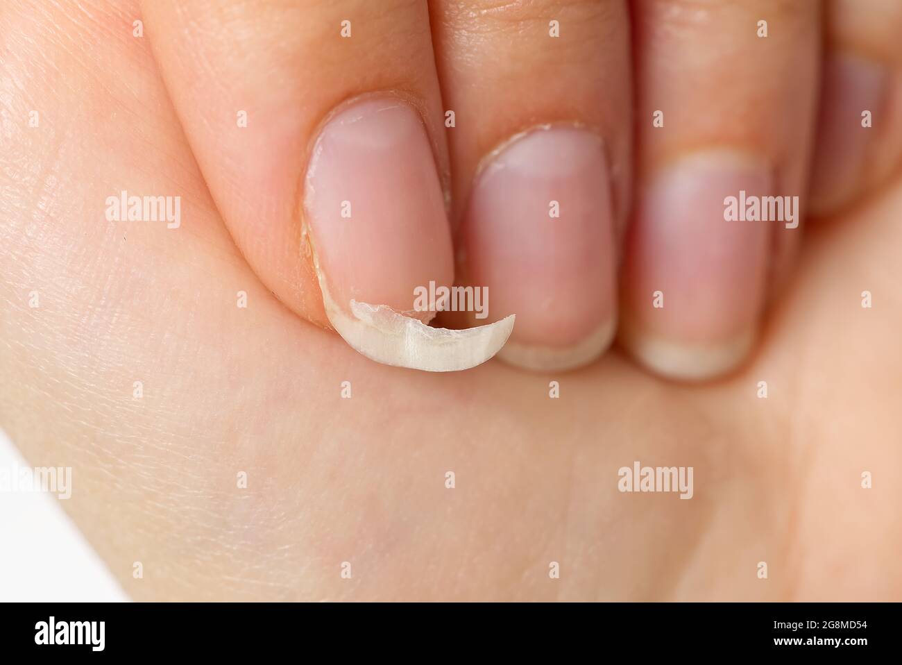 broken nail on a female hand. close-up shoot of broken nail. brittle  fingernail Stock Photo - Alamy