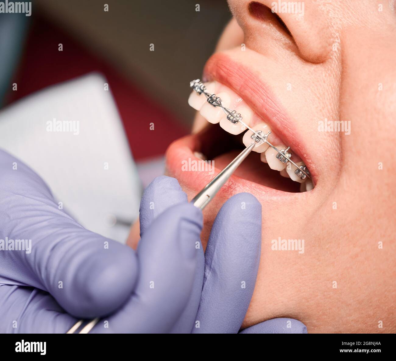 Close up of dentist hand in serial glove putting elastic rubber band on patient brackets. Woman