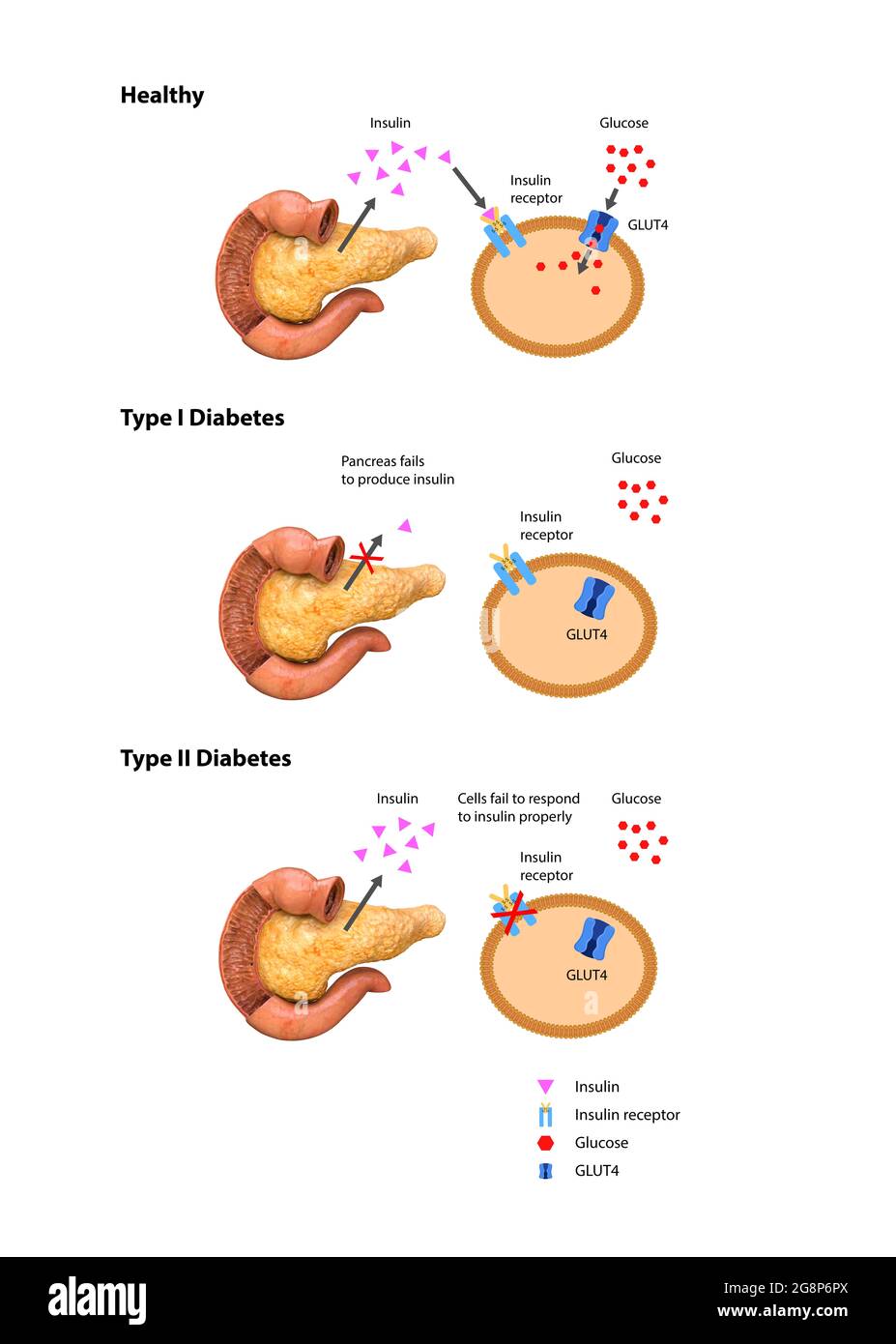 Type 2 diabetes diagram hires stock photography and images Alamy