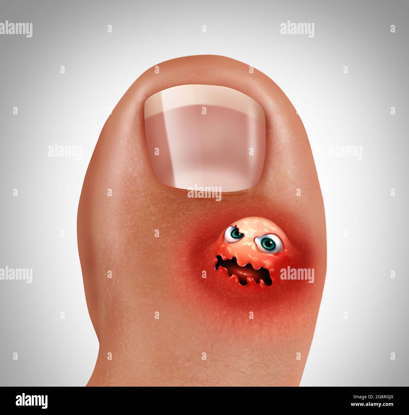 Toe blister or foot wart concept as sore corn or painful feet skin  representing a foot infection or feet injury in a 3D illustration style. Stock Photo
