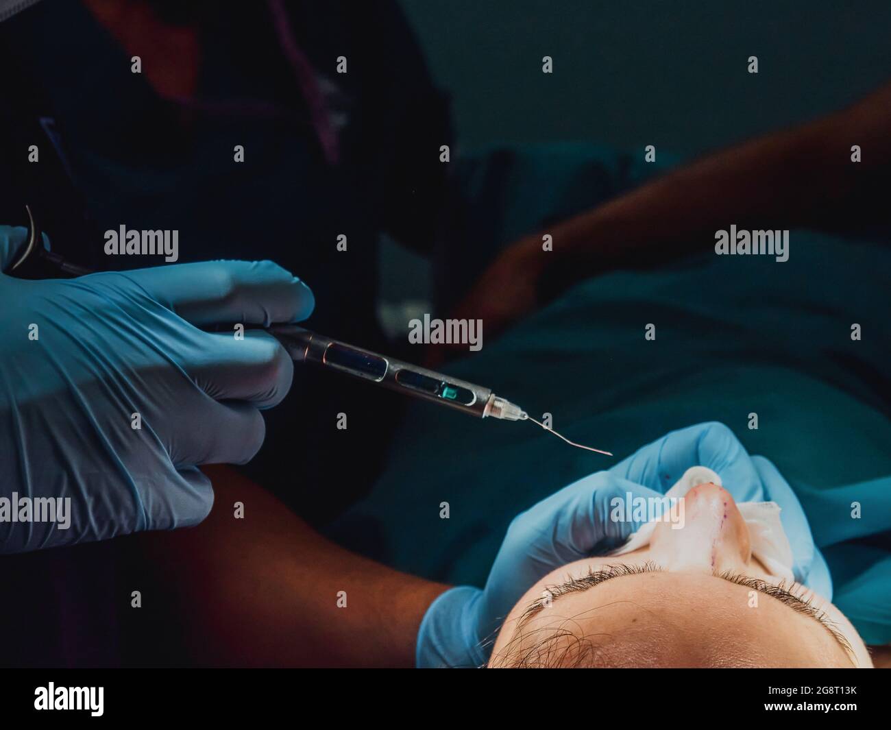 Surgeon doctor doing rhinoplasty surgery inside operating room at modern hospital - Focus on patient head Stock Photo